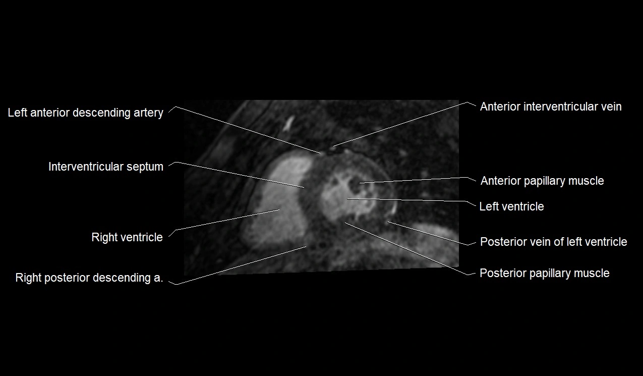 MRI heart and coronary arteries short axis anatomy image 26.webp